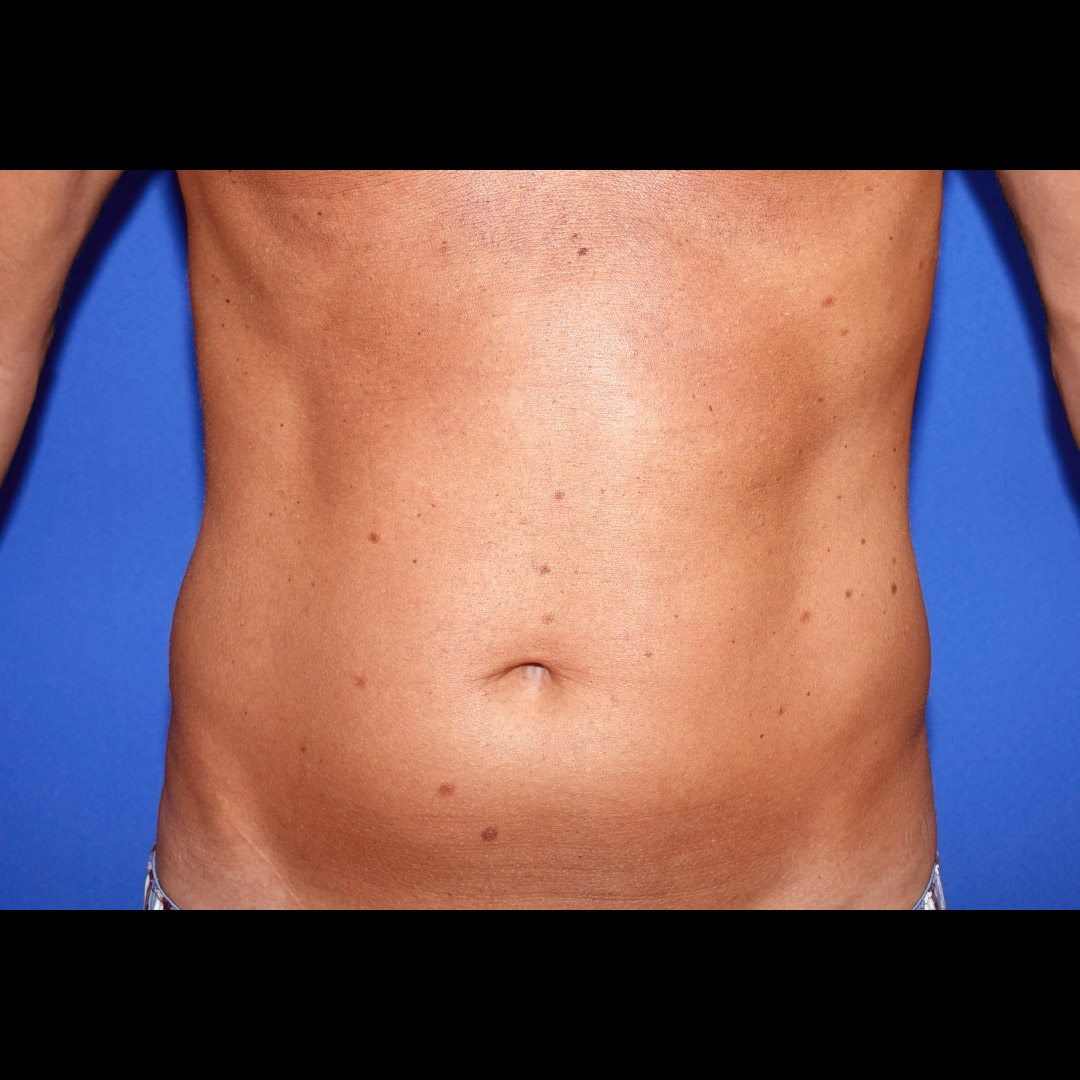 Vorher Nachher Fettabsaugung, 51 Perfekter Körper®, Fettabsaugung & Körperstraffung Wien
