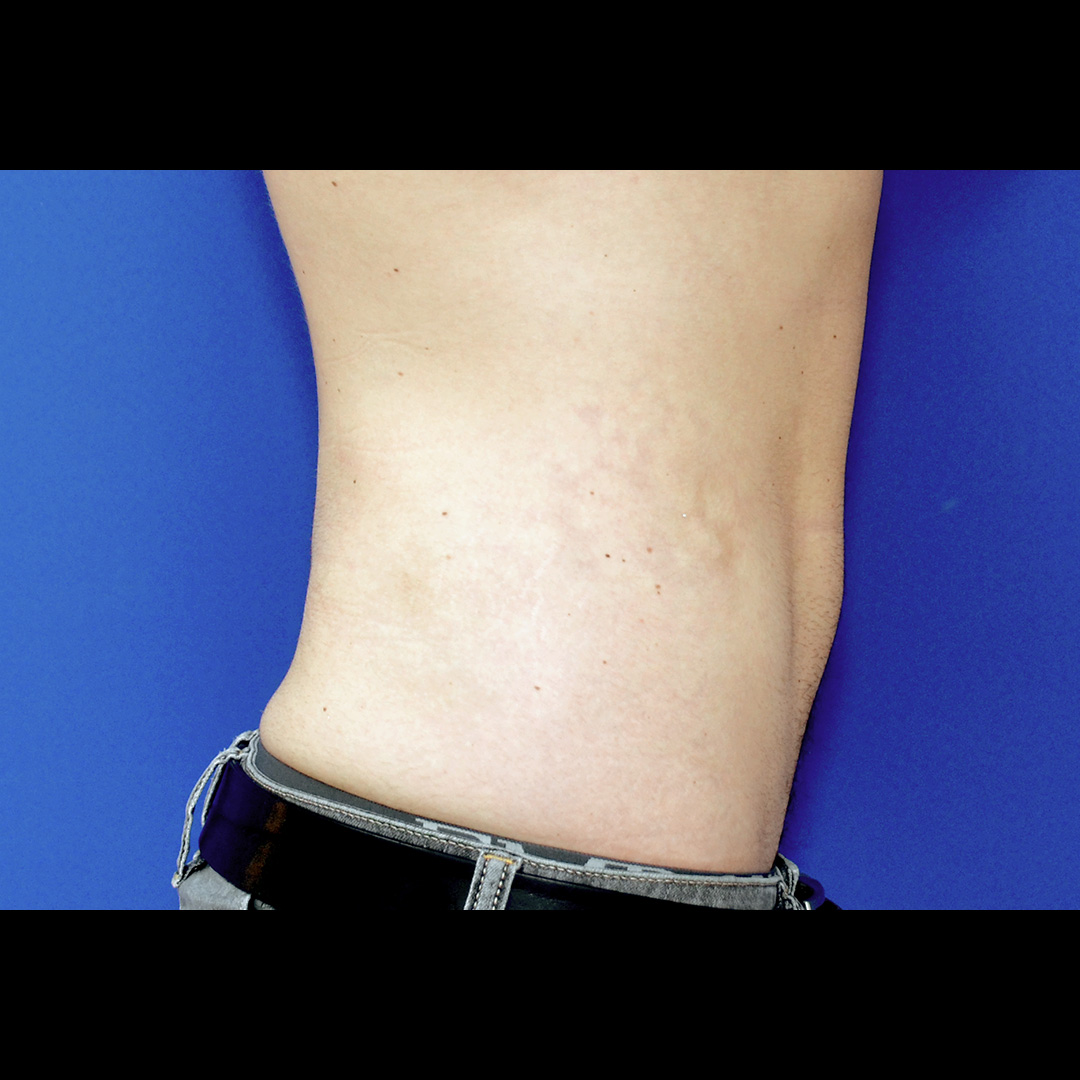 Vorher Nachher Fettabsaugung, 29 Perfekter Körper®, Fettabsaugung & Körperstraffung Wien