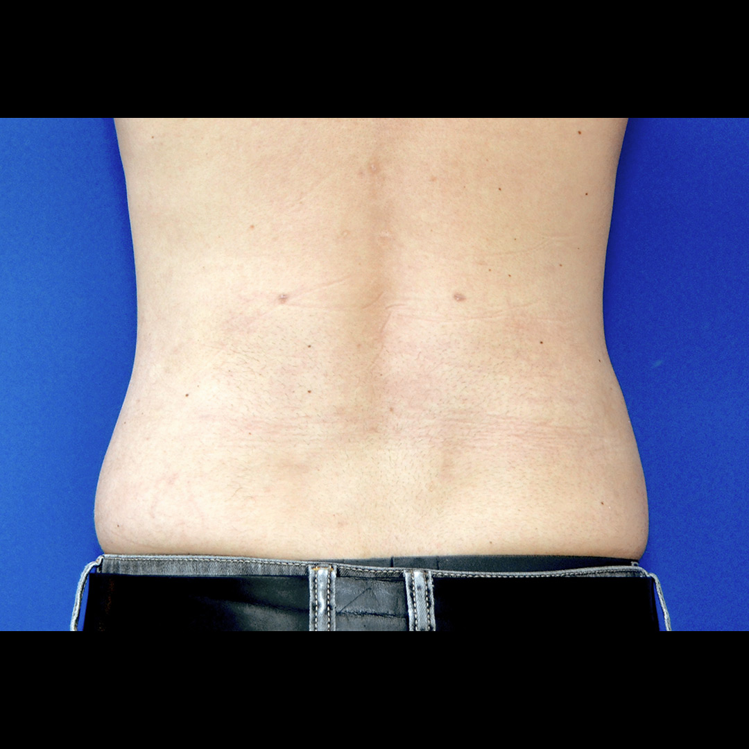 Vorher Nachher Fettabsaugung, 29 Perfekter Körper®, Fettabsaugung & Körperstraffung Wien