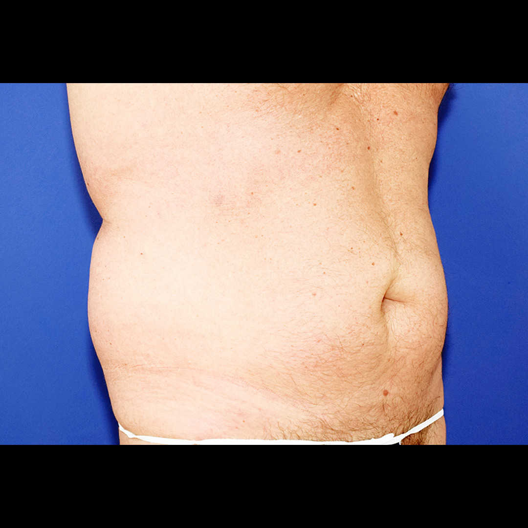 Vorher Nachher Fettabsaugung, 58 Perfekter Körper®, Fettabsaugung & Körperstraffung Wien
