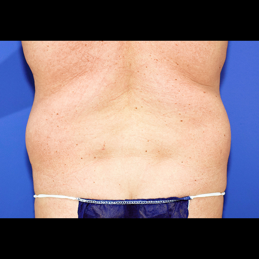 Vorher Nachher Fettabsaugung, 58 Perfekter Körper®, Fettabsaugung & Körperstraffung Wien