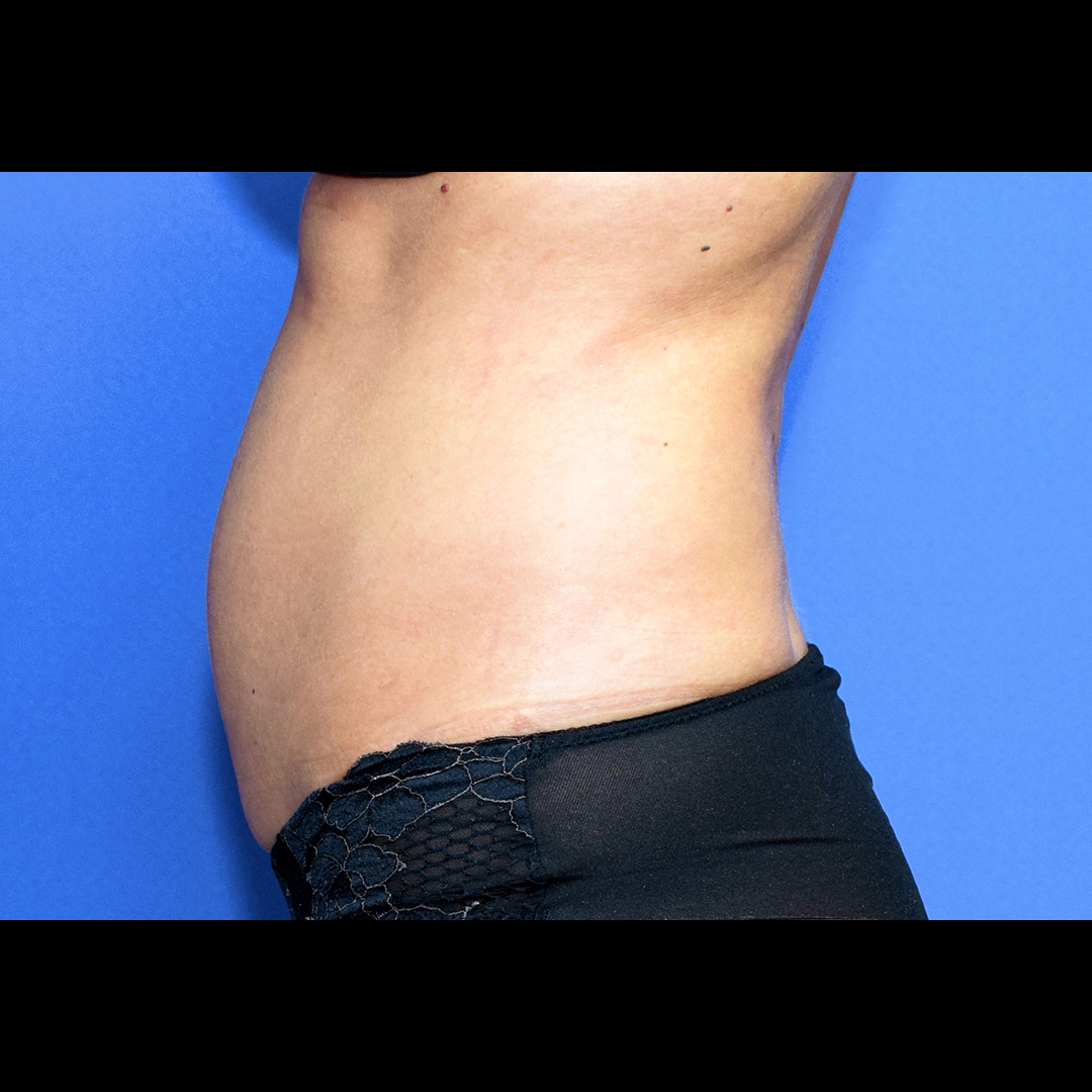 Vorher Nachher Fettabsaugung, 33 Perfekter Körper®, Fettabsaugung & Körperstraffung Wien