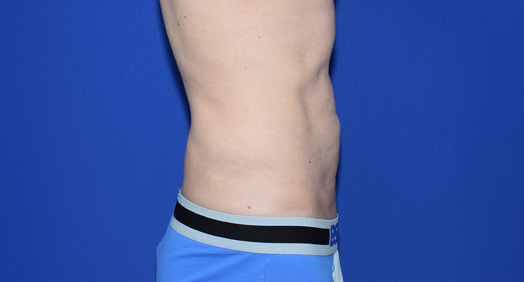 Vorher Nachher Fettabsaugung, 45 Perfekter Körper®, Fettabsaugung & Körperstraffung Wien