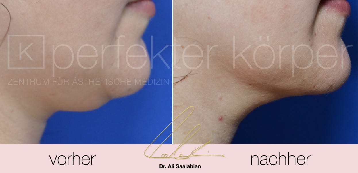 Fettabsaugung Hals/Doppelkinn Perfekter Körper, 1010 Wien